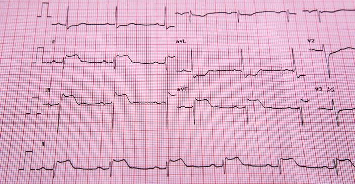 EKG - STEMI - tanda-tanda elevasi ST dan infark otot jantung