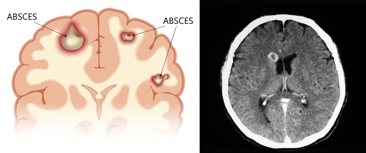 Tampilan anatomi dan CT scan dari abses otak