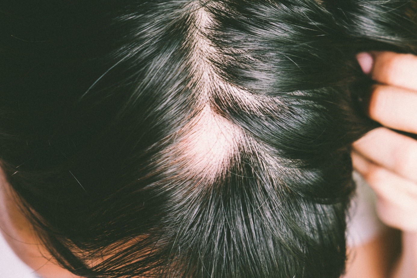 Alopecia, kepala, rambut hitam, kondisi rambut rontok yang berlebihan