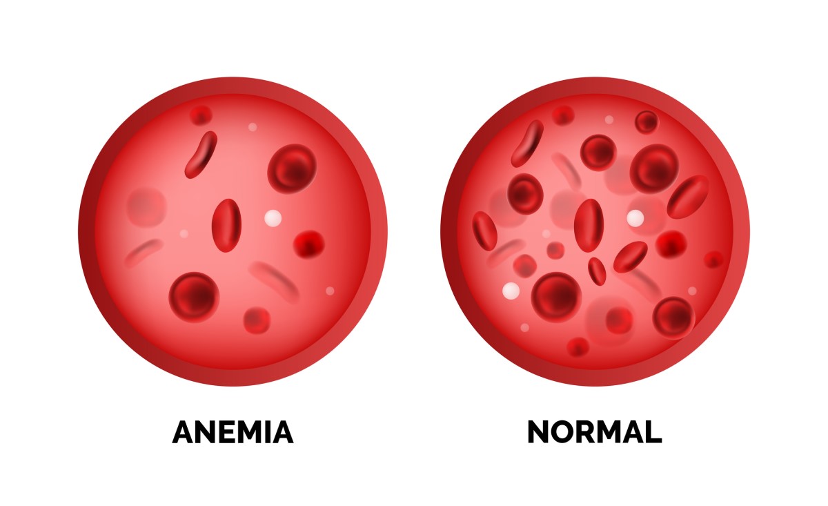 Anemia dan kadar sel darah merah normal