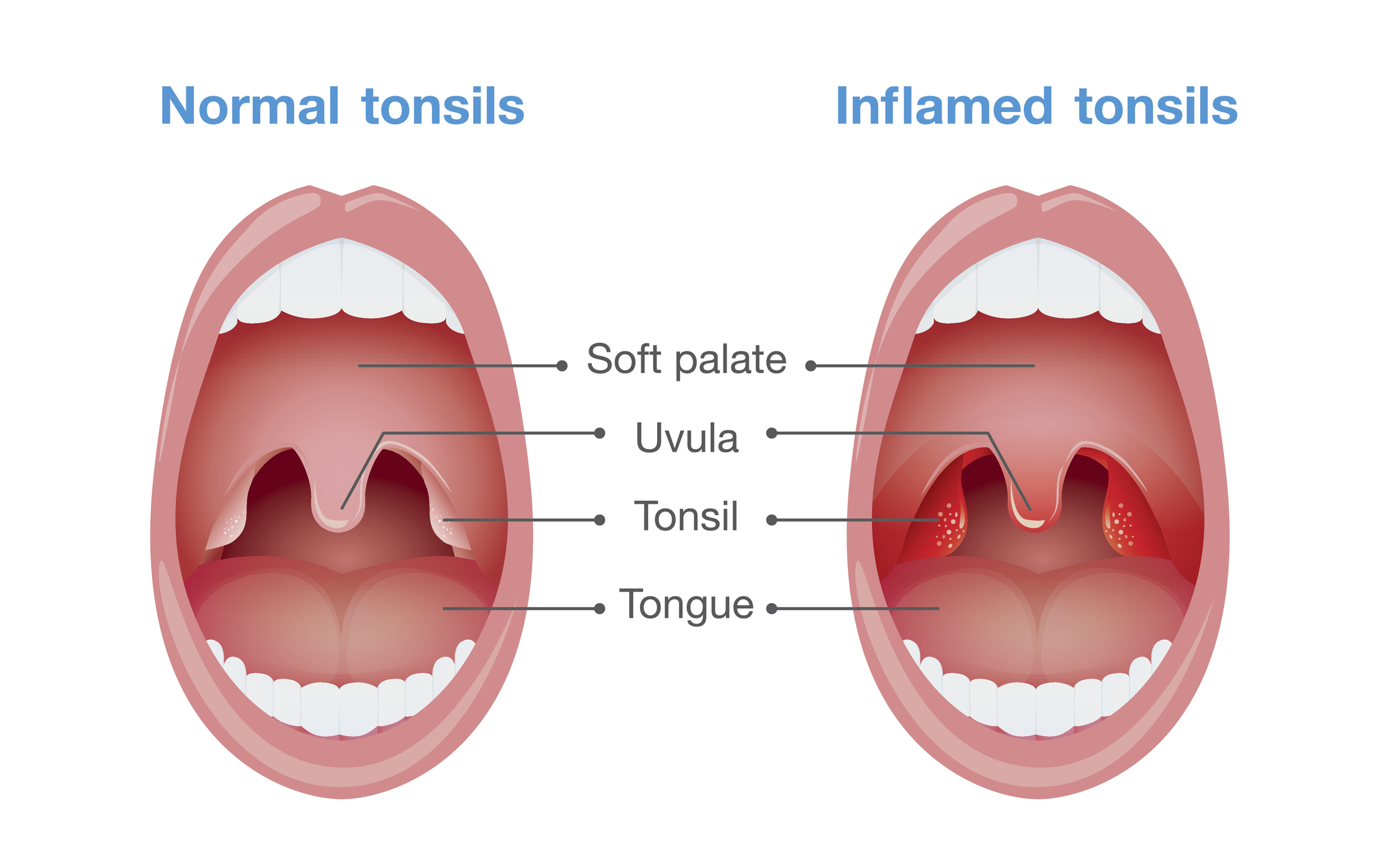 Angina - radang amandel