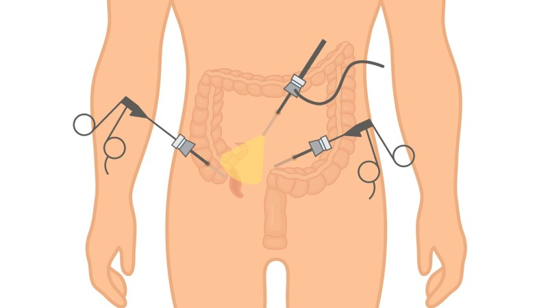 Representasi model laparoskopi pada radang usus buntu