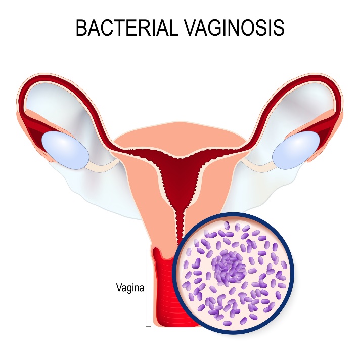 Vaginosis bakteri dan pertumbuhan berlebih Gardnerella vaginalis