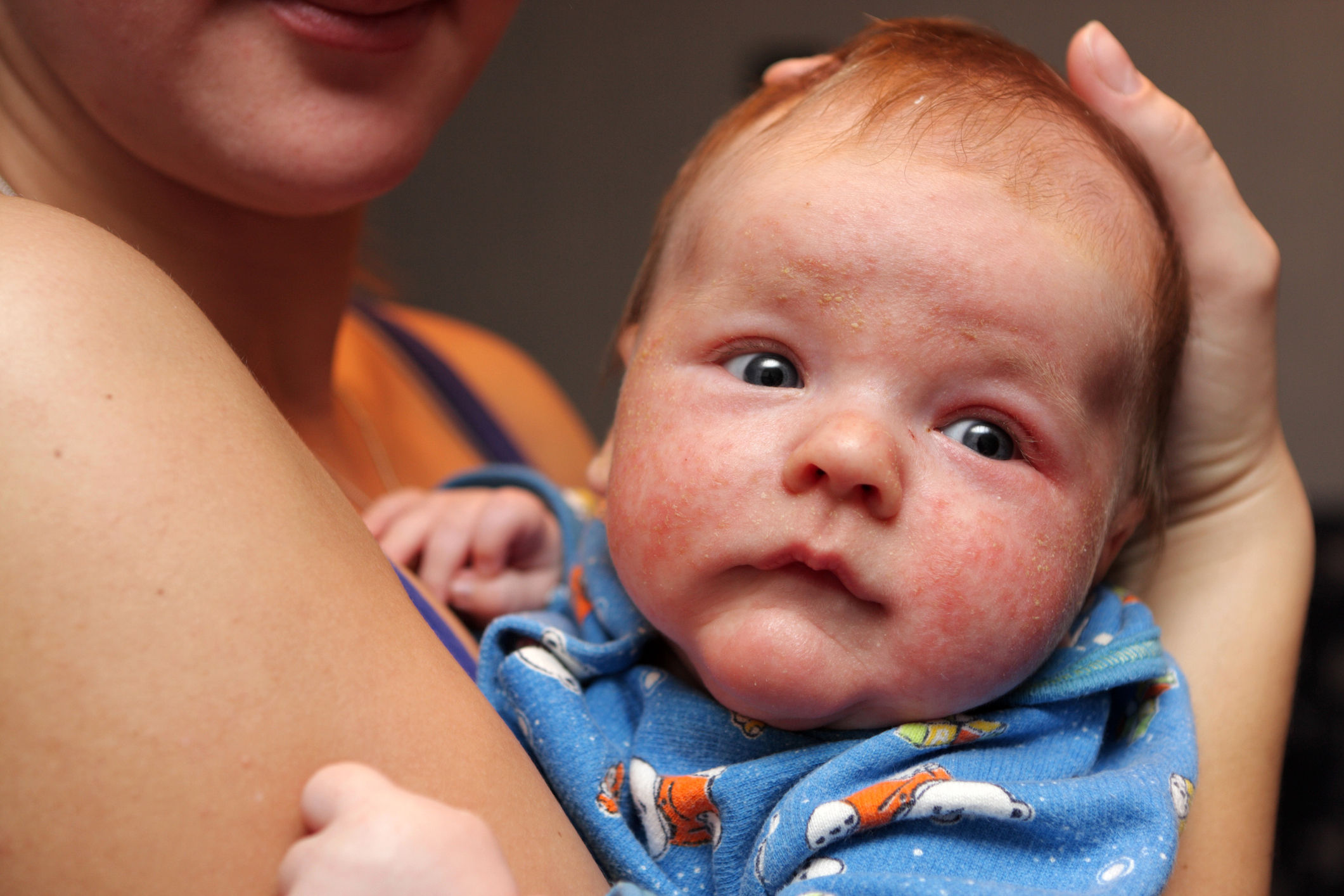 Dermatitis pada wajah anak kecil