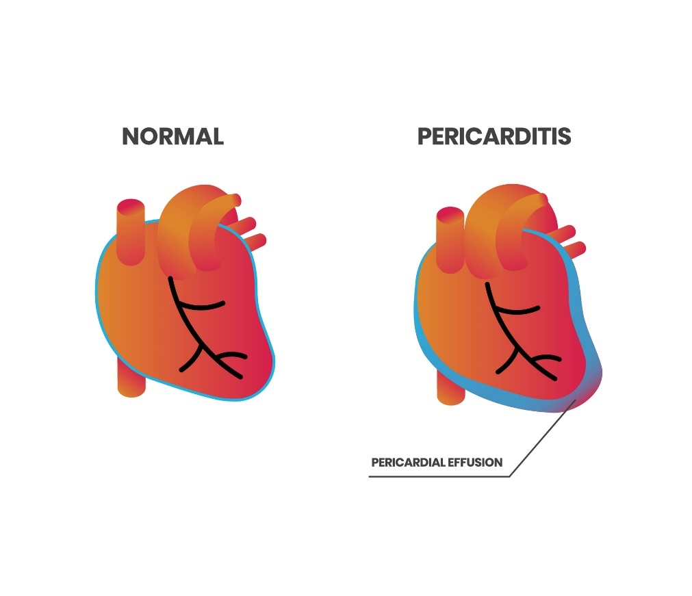 Fisiologi jantung dan perikarditis (efusi perikardial)