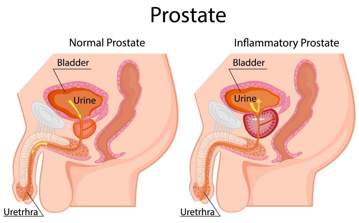 Kiri: prostat fisiologis. Kanan: prostat yang membesar. Terletak di bawah kandung kemih. Kandung kemih, air seni, uretra.