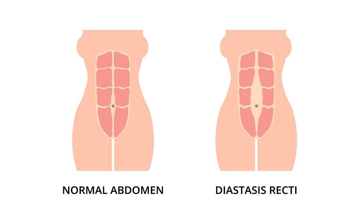 Keadaan fisiologis otot perut dan diastasis (jarak) otot rektus abdominis kiri dan kanan dari garis tengah linea alba