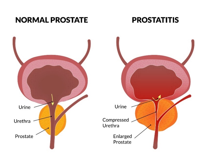 Keadaan fisiologis prostat dan prostatitis