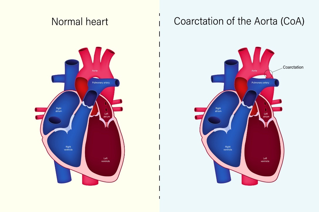 Kondisi fisiologis jantung dan koarktasio aorta (CoA)