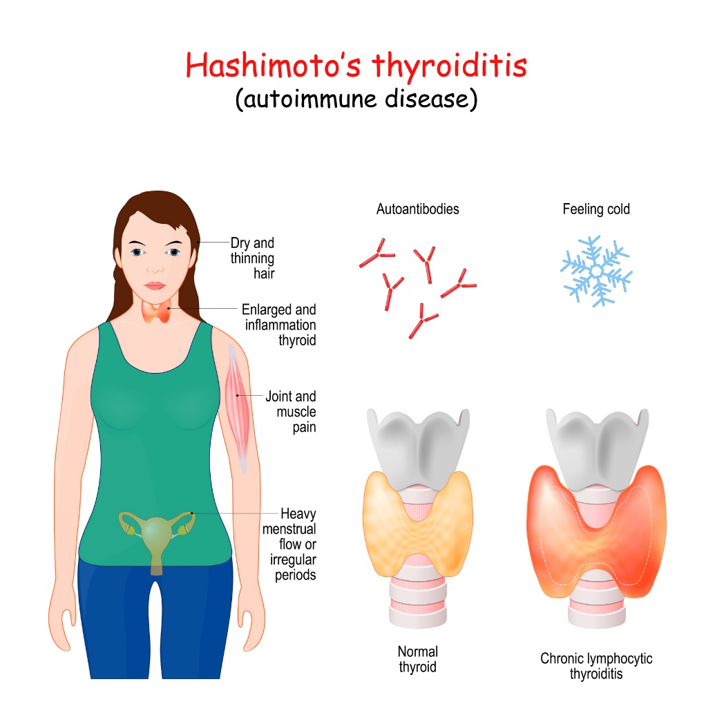 Tiroiditis Hashimoto dan gejala klinis