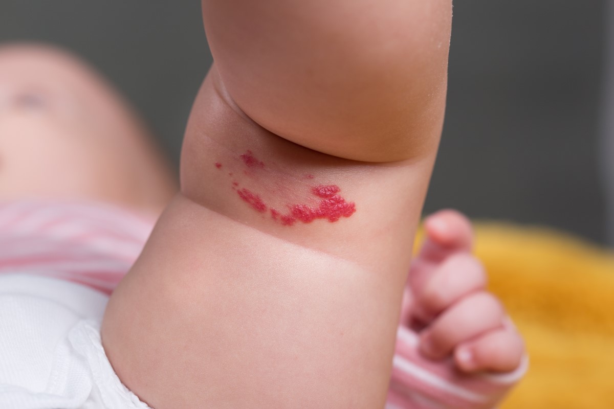 Hemangioma pada paha bagian dalam anak