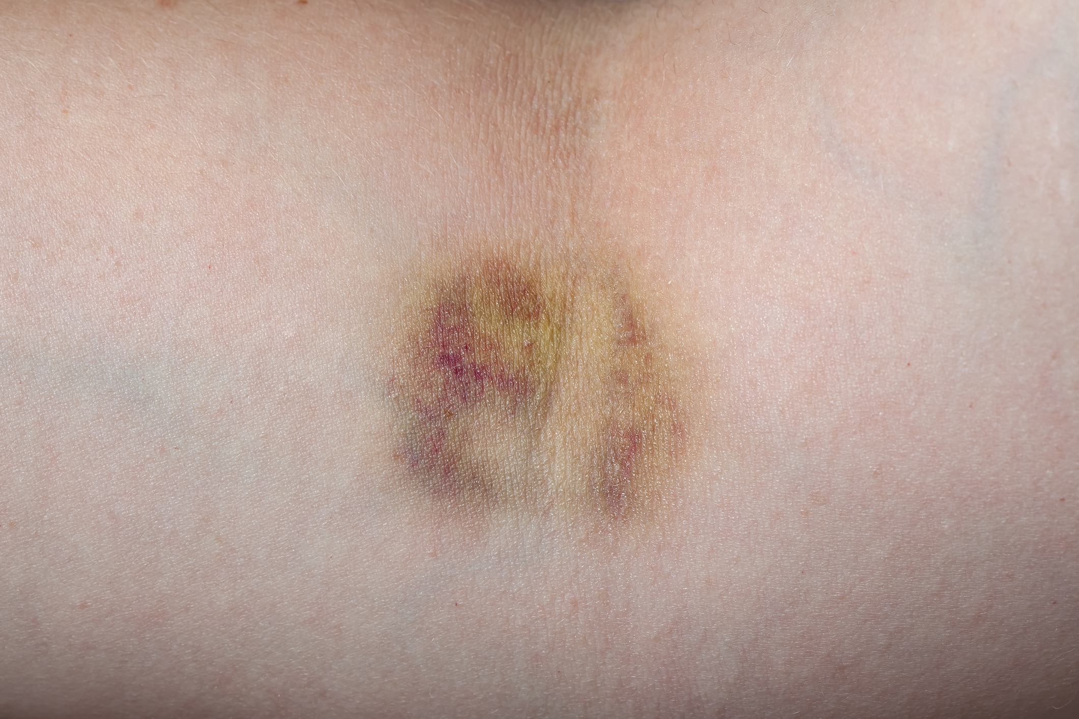 Hematoma (memar)