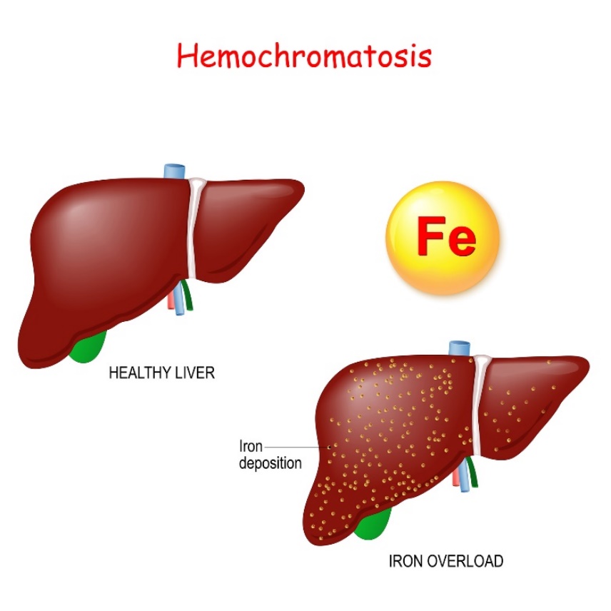 Hemokromatosis: fisiologi dan patologi hati dengan pengendapan zat besi (Fe) yang berlebihan