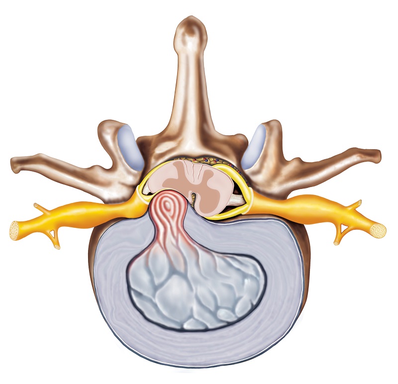 Diskus hernia - representasi anatomi