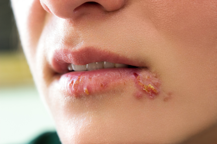 Herpes simpleks pada wajah - bibir dan sudut mulut