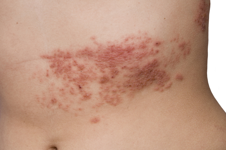 Herpes zoster di perut