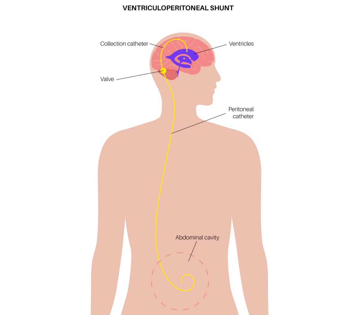 Ilustrasi pirau ventrikulo-abdomen yang mengalirkan cairan berlebih dari otak ke dalam rongga perut.