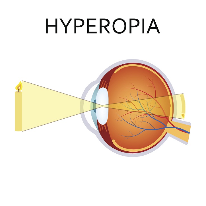 Hiperopia