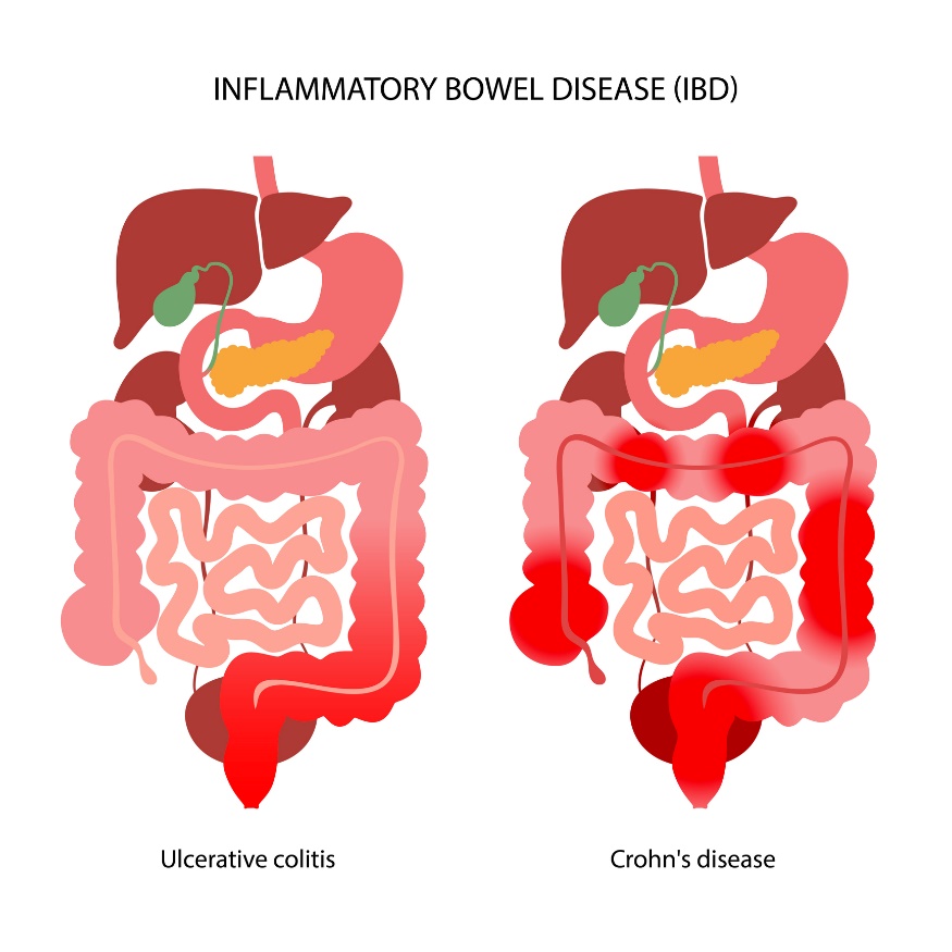 IBD: Pembagian menjadi kolitis ulseratif dan penyakit Crohn menurut lokalisasi reaksi inflamasi.