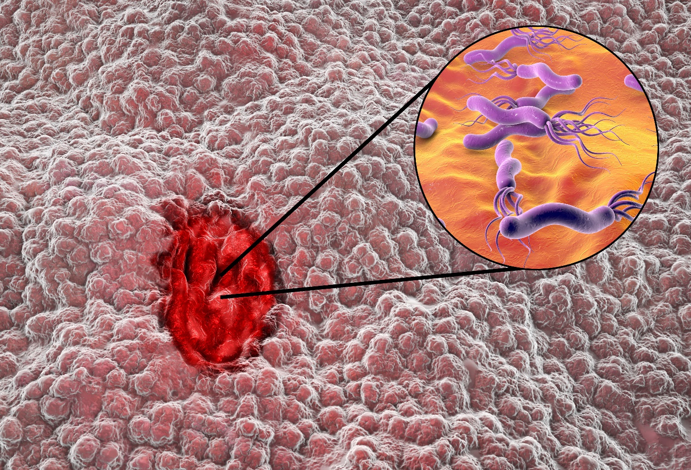 Infeksi Helicobacter pylori