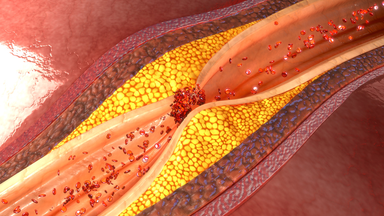 Angina pektoris dan aterosklerosis serta plak aterosklerotik di pembuluh darah koroner atau jantung