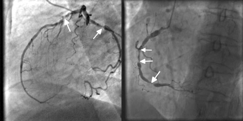 Koronarografi, angiografi, penyumbatan arteri koroner