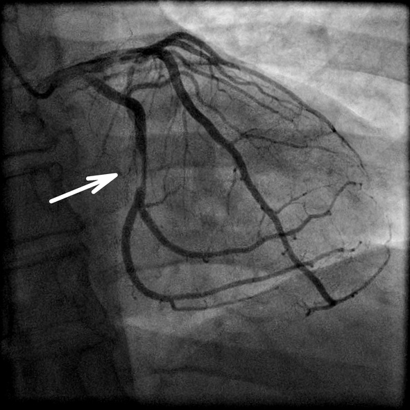 Koronarografi dan penyempitan arteri jantung