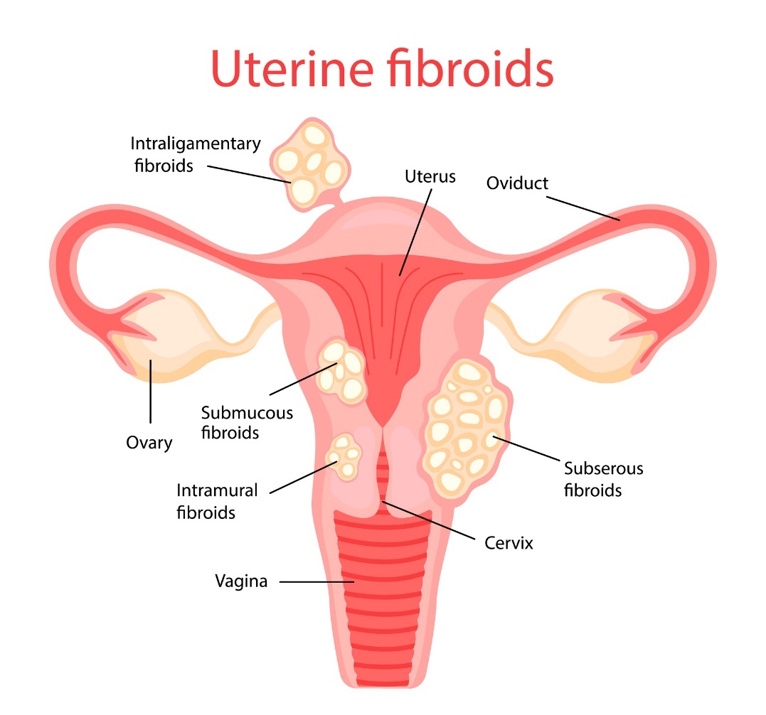 Fibroid uterus (fibroid rahim)