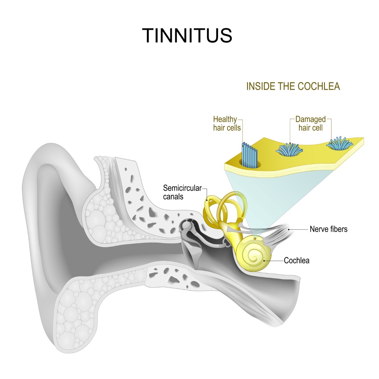 Telinga bagian dalam dan tinnitus - bersiul dan bersenandung di telinga