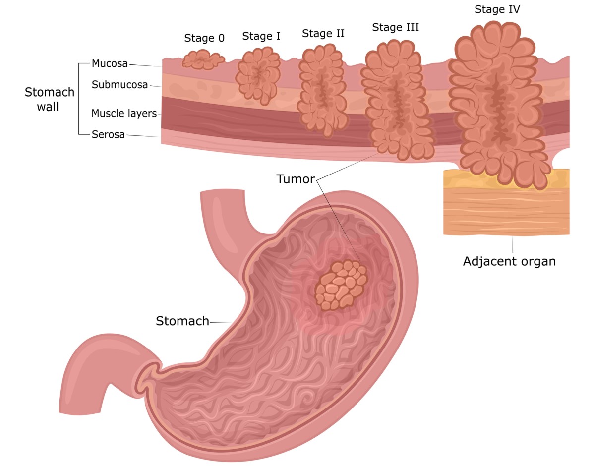 Kanker lambung: lapisan dinding lambung (mukosa, submukosa, otot, serosa) dan tahapan perkembangan tumor dari mukosa ke sekitarnya dan organ.