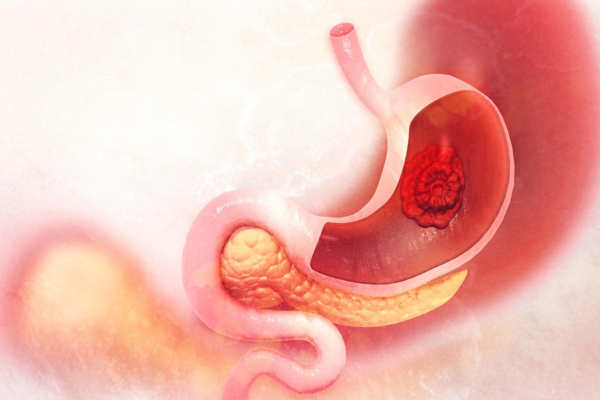 Visualisasi tumor ganas yang terlokalisasi di dalam perut.