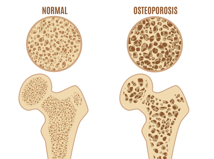 Osteoporosis tulang paha