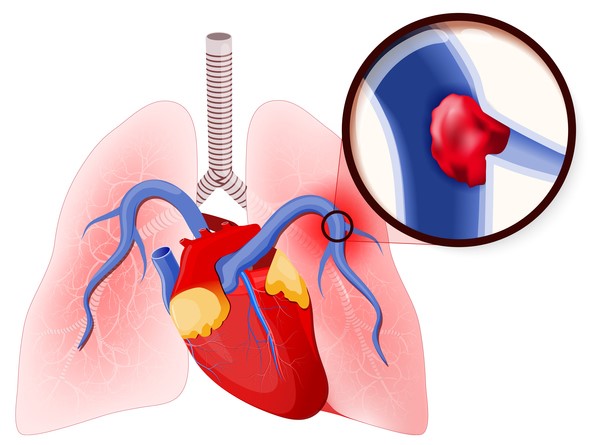 Emboli paru, penutupan arteri pulmonalis oleh gumpalan darah