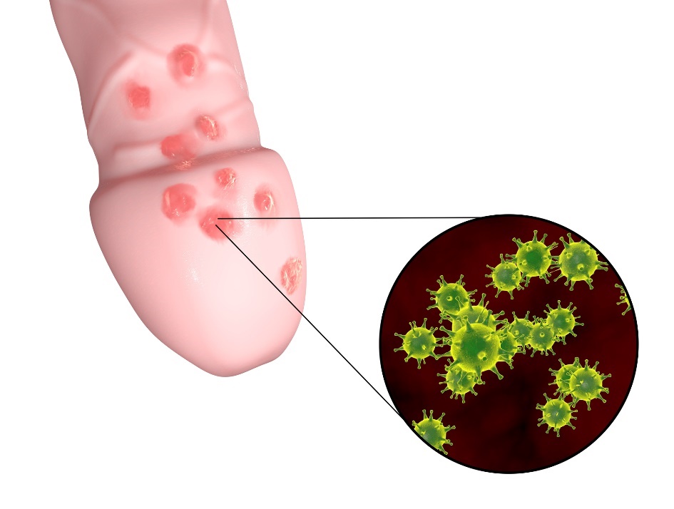 Terbentuknya lepuhan herpes genital kecil di area genital organ pria.