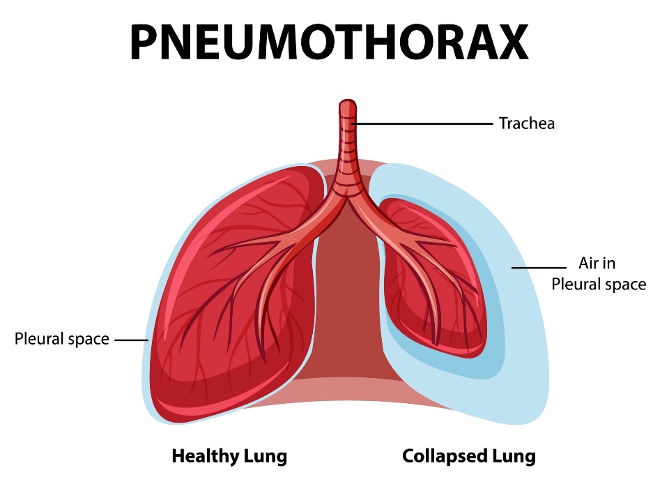 Pneumotoraks: paru-paru yang sehat dan kolaps