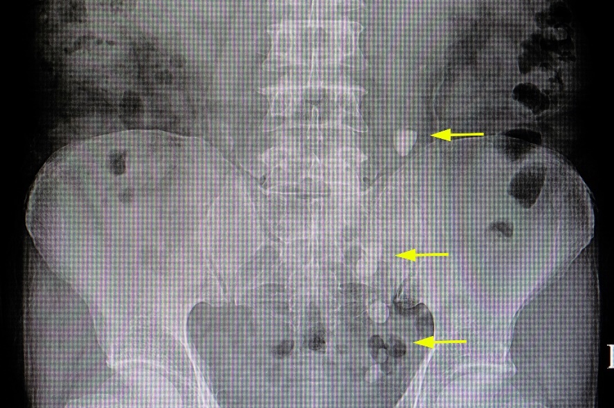 X-ray: banyak penambahan dalam perjalanan saluran kemih