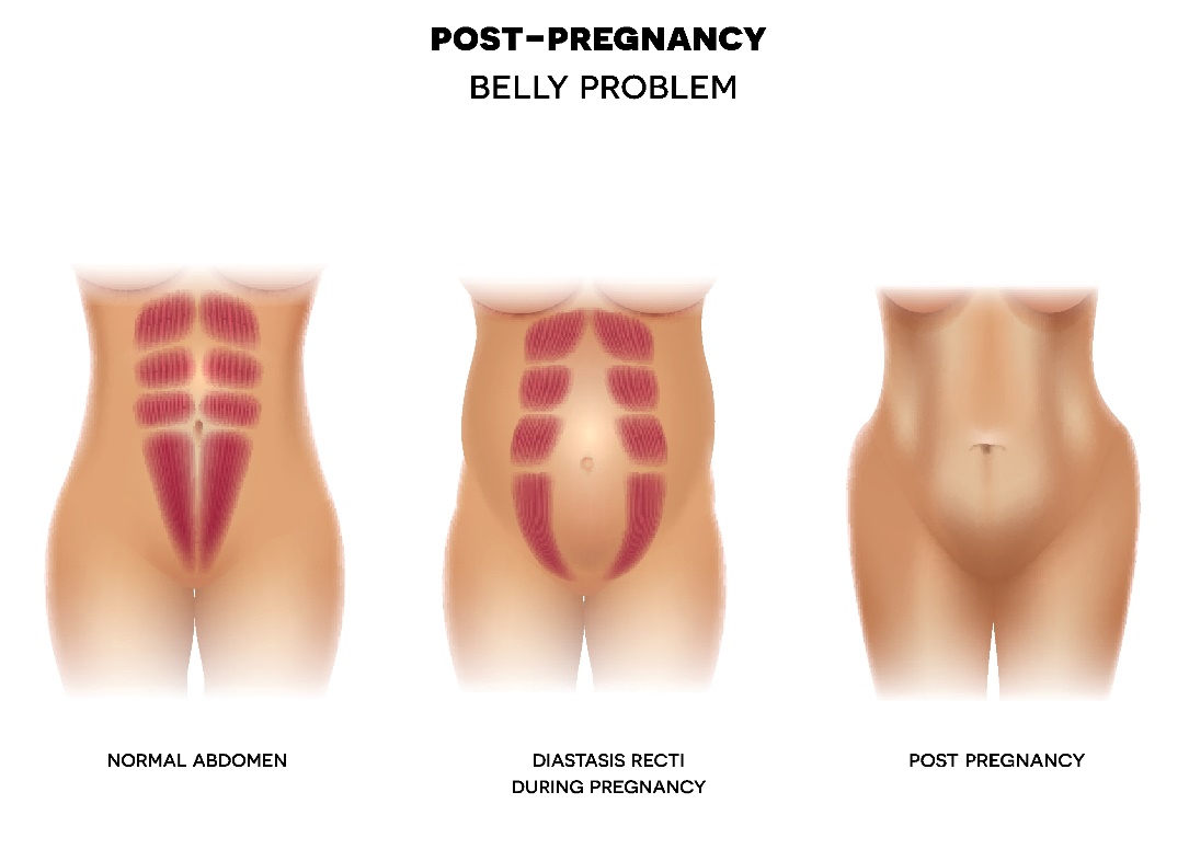 Diastasis pascapersalinan pada dinding perut