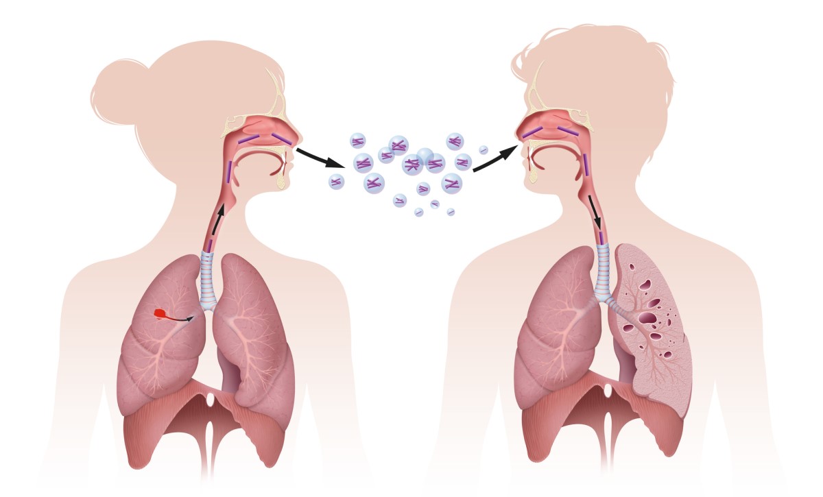 Penularan TB melalui inhalasi, yaitu melalui inhalasi, gambar menunjukkan penularan melalui inhalasi.