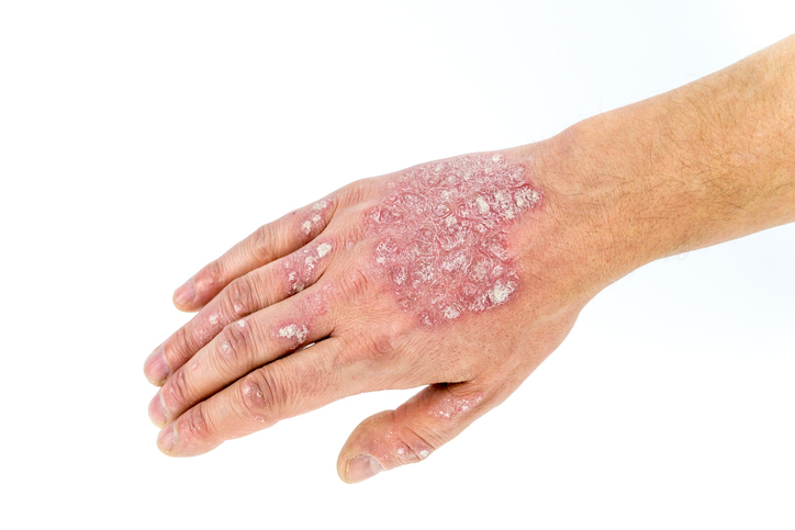 Psoriasis atau psoriasis di tangan, punggung tangan