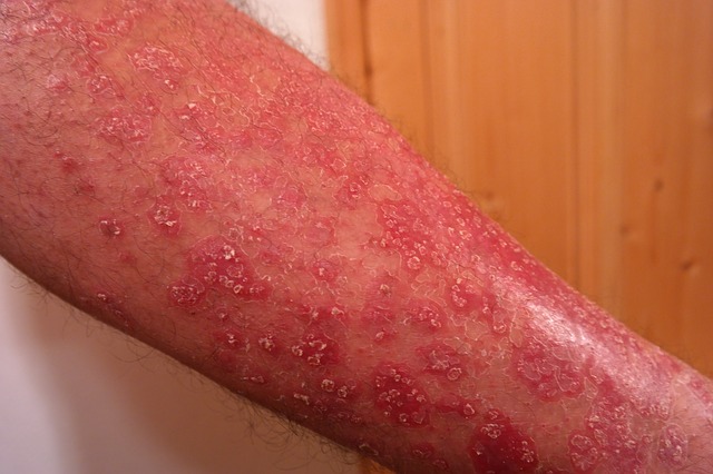 Psoriasis pada tungkai atas, di lengan bawah