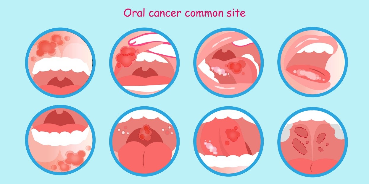 Kanker mulut dan endapan tumor - sebuah model