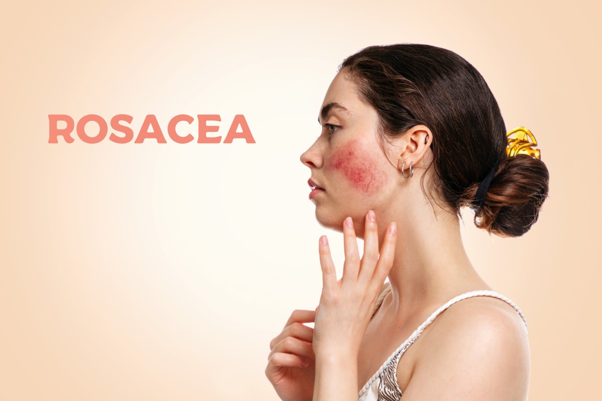 Wanita dari samping, wajah dengan rosacea - rosacea