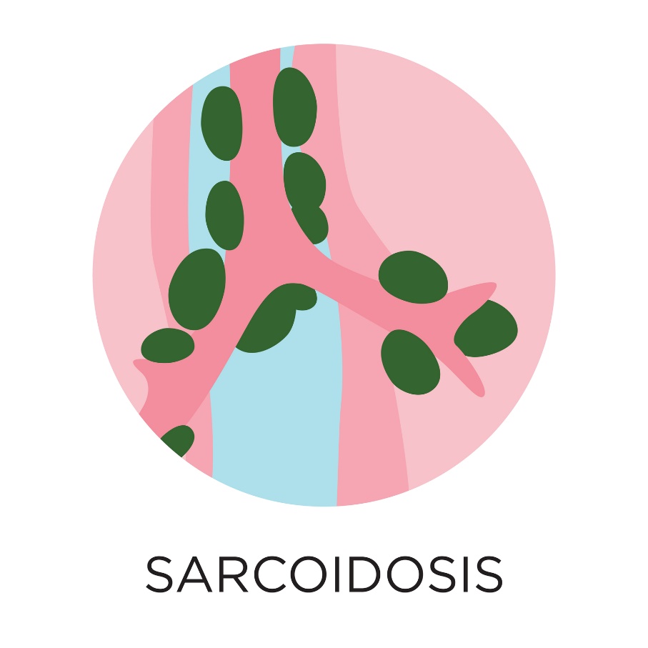 Sarkoidosis - pembentukan granuloma