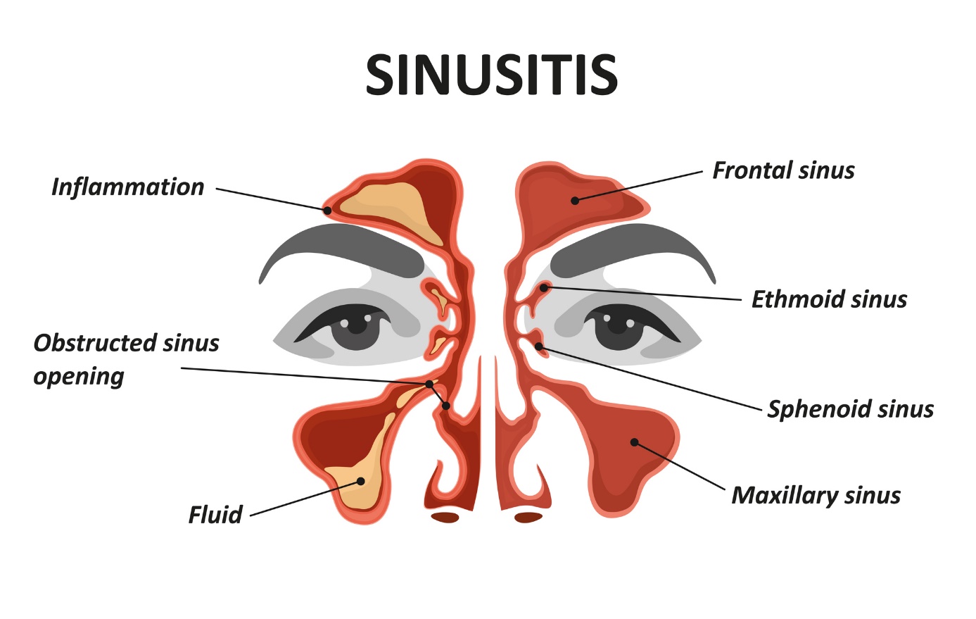 Model/gambar animasi sinusitis dan sinusitis