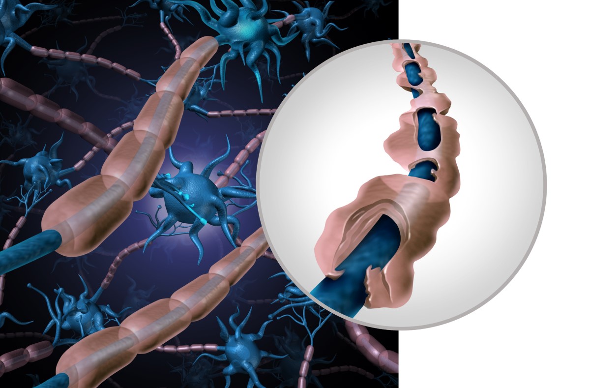 Representasi anatomis dan bergambar dari serat neuron yang sehat dan rusak - demielinasi