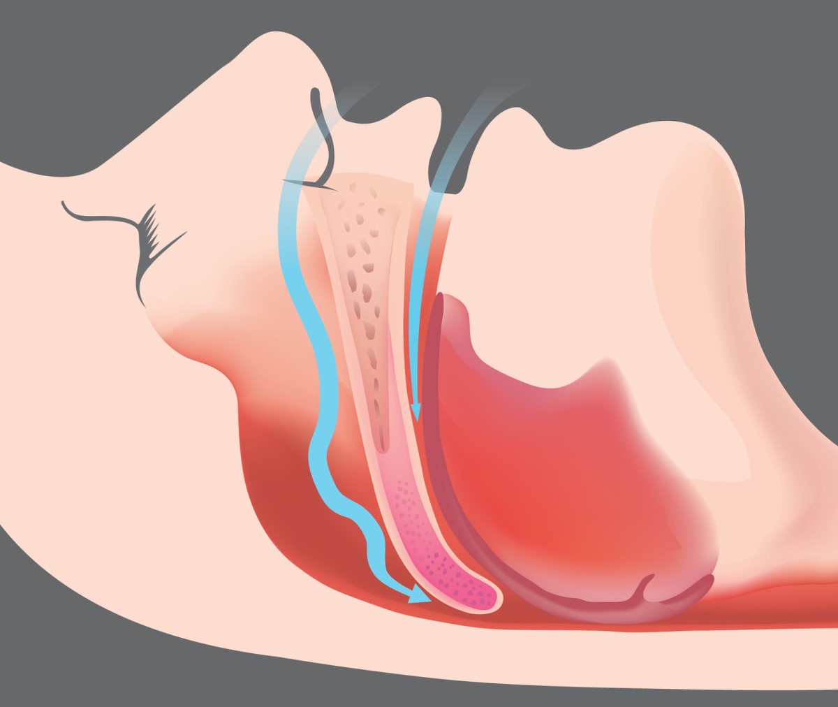 Apnea obstruktif dan obstruksi jalan napas - gambar animasi dan model jalan napas