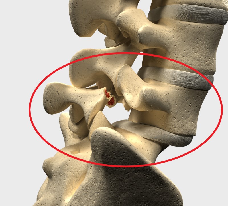 Spondylolisthesis di daerah lumbal L5 dan S1 - model kerangka tulang belakang