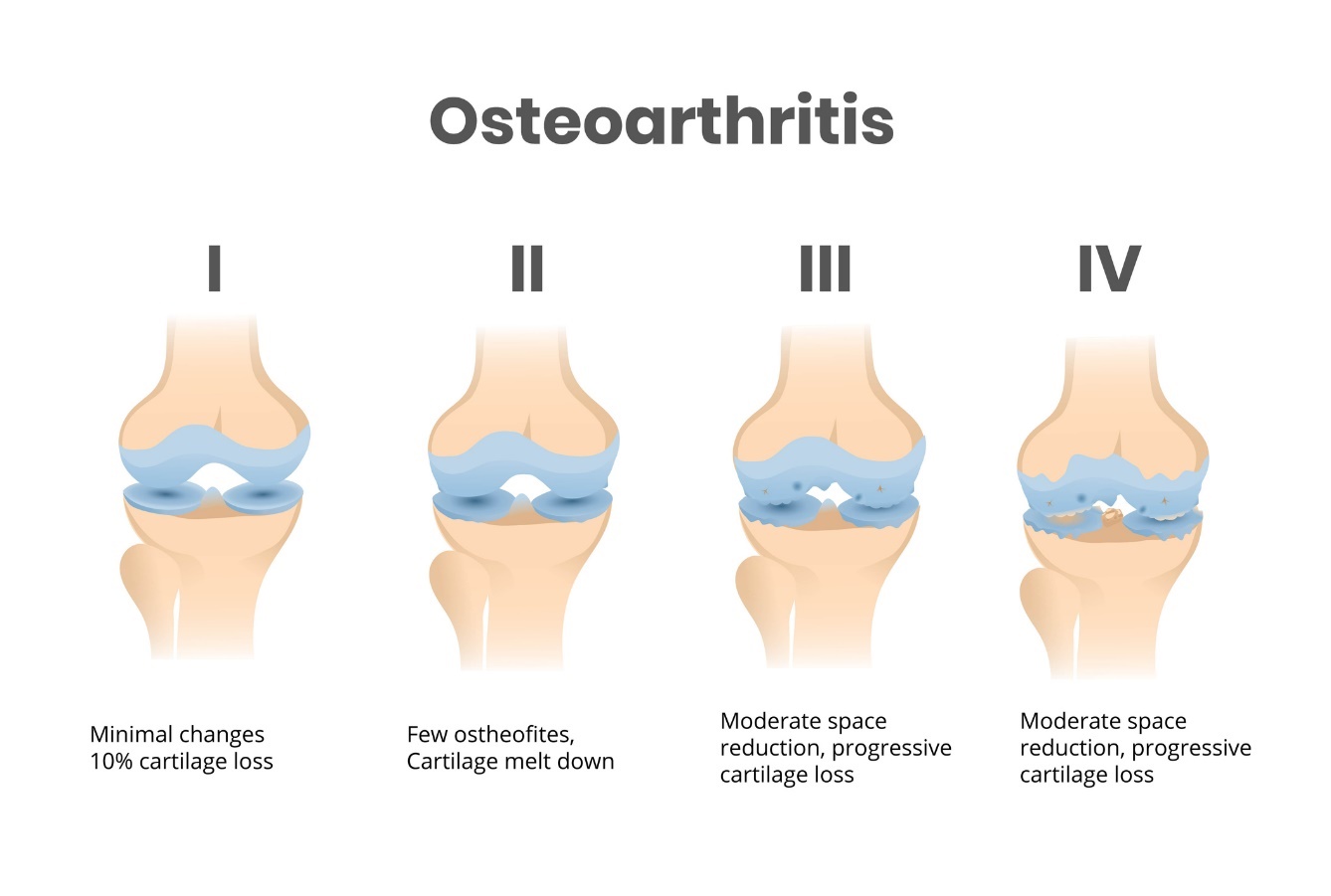 4 tahap arthrosis