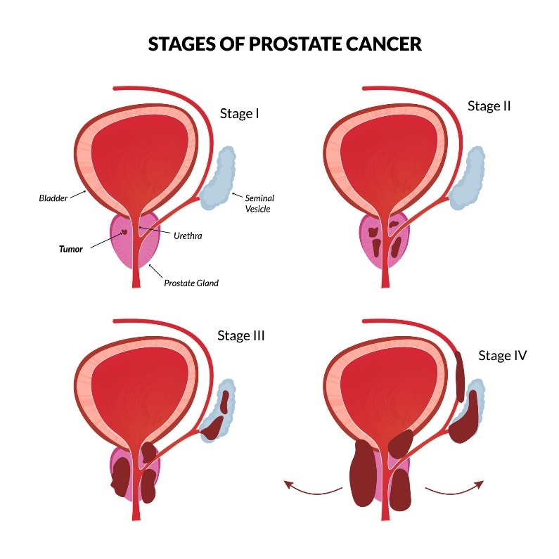 4 tahap dasar kanker prostat