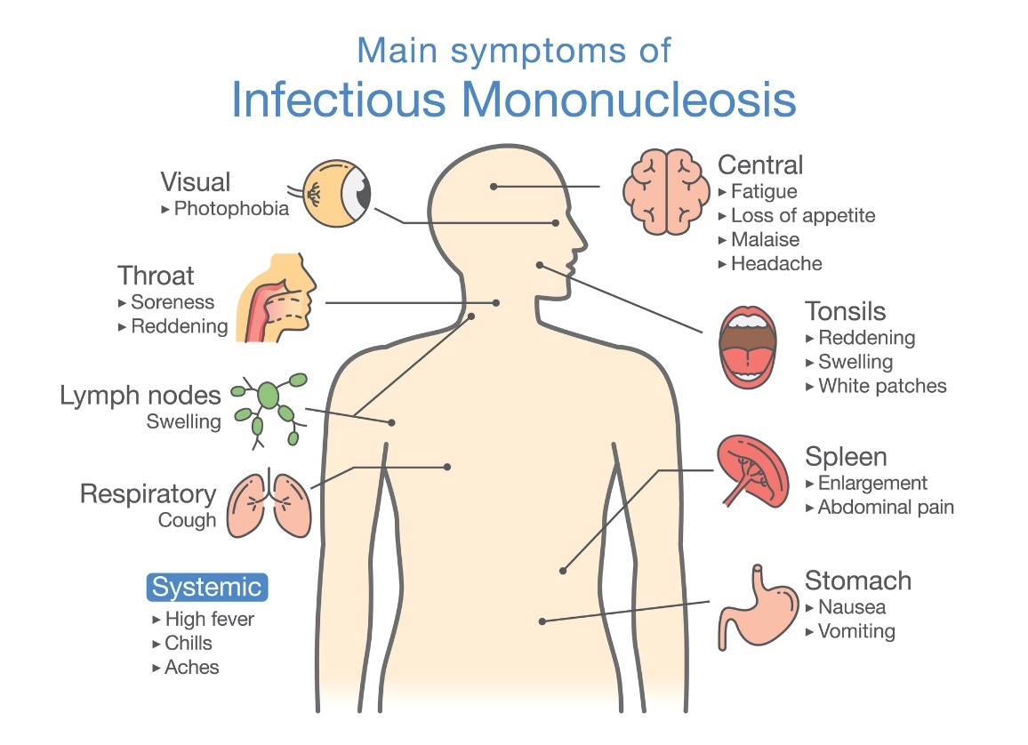 Gejala mononukleosis menular